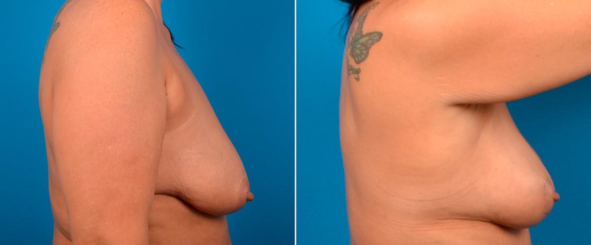 Breast Lift Before & After Gallery - Patient 317297 - Image 2