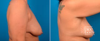 Hidden Breast Lift Before & After Gallery - Patient 111996 - Image 2