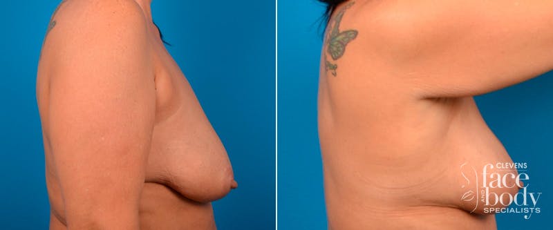 Hidden Breast Lift Before & After Gallery - Patient 111996 - Image 2