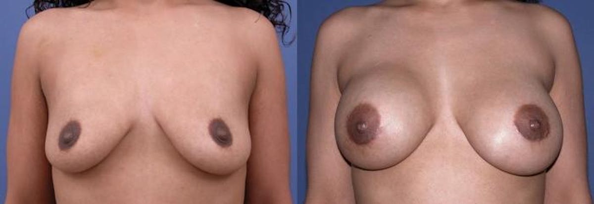 Breast Augmentation Before & After Gallery - Patient 122405454 - Image 1