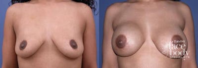 Hidden Breast Aug Before & After Gallery - Patient 638545 - Image 1
