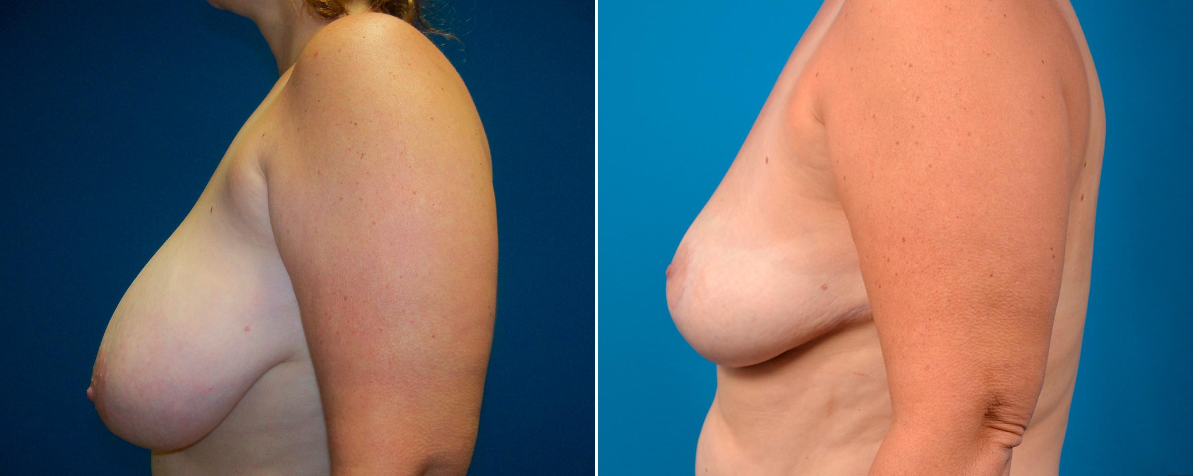 Hidden Breast Reduction Before & After Gallery - Patient 343745 - Image 3