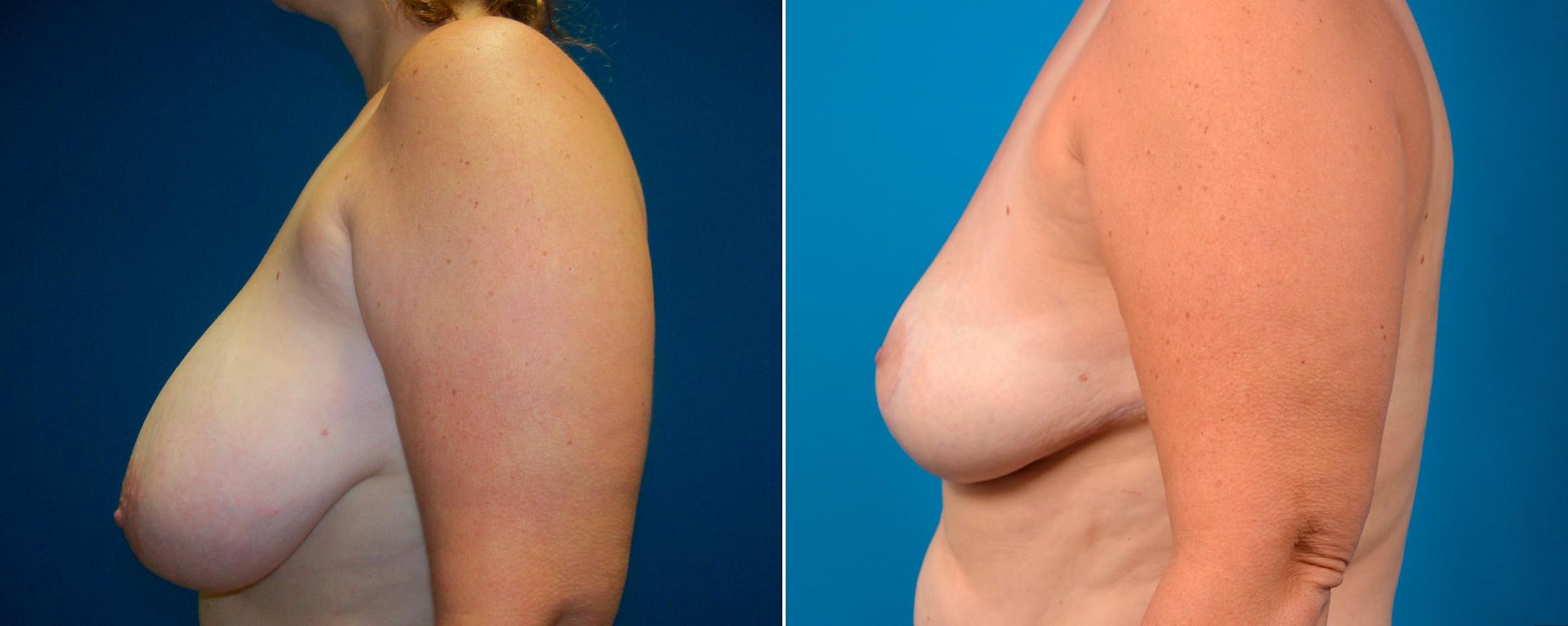 Breast Reduction Before & After Gallery - Patient 122405452 - Image 3