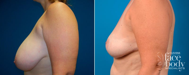 Hidden Breast Reduction Before & After Gallery - Patient 158033 - Image 3