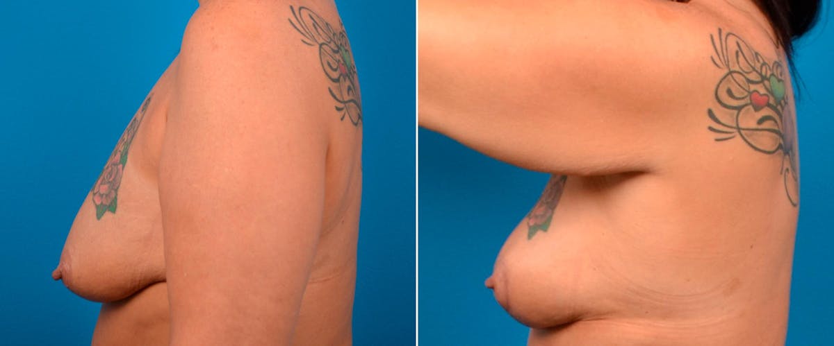 Breast Lift Before & After Gallery - Patient 317297 - Image 3