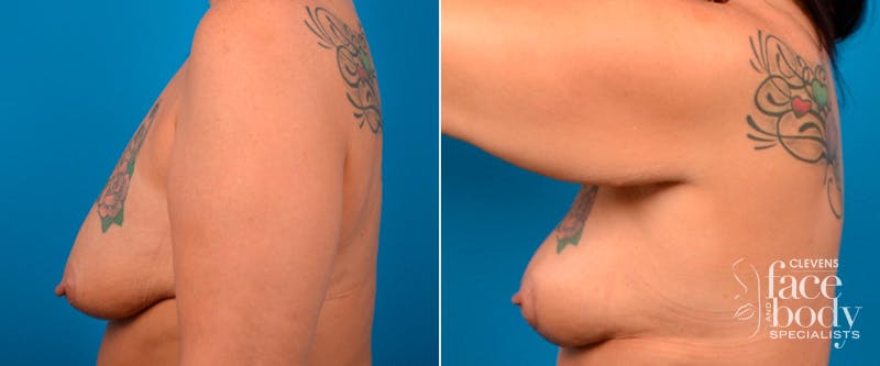 Hidden Breast Lift Before & After Gallery - Patient 111996 - Image 3