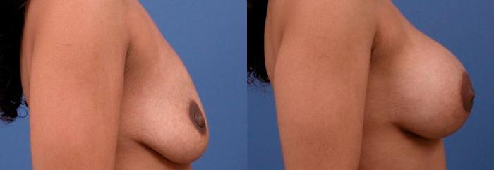 Hidden Breast Aug Before & After Gallery - Patient 178834 - Image 2