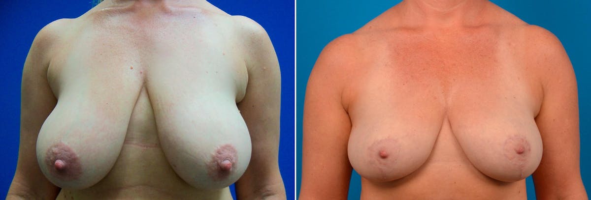 Hidden Breast Reduction Before & After Gallery - Patient 368955 - Image 1