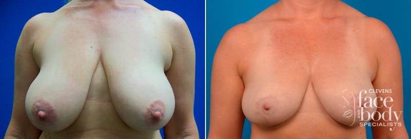 Hidden Breast Reduction Before & After Gallery - Patient 368955 - Image 1