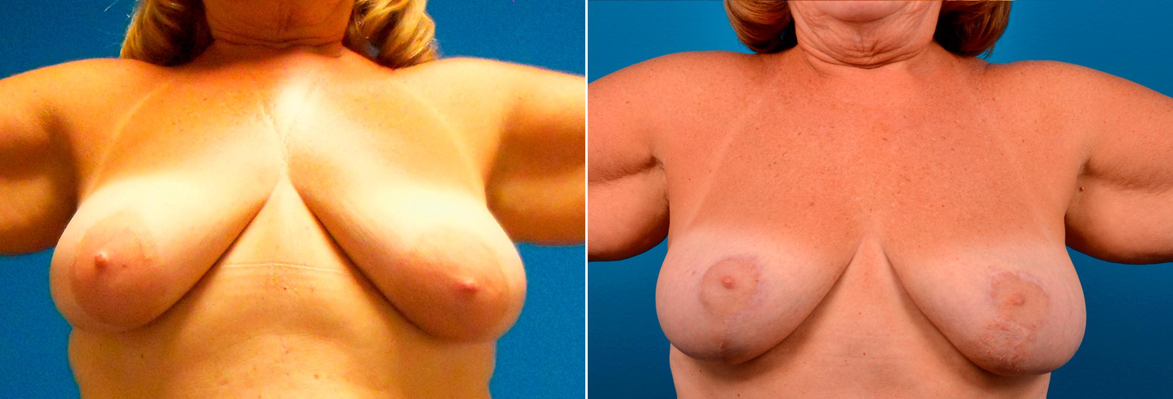 Hidden Breast Lift Before & After Gallery - Patient 410022 - Image 1