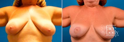 Hidden Breast Lift Before & After Gallery - Patient 410022 - Image 1