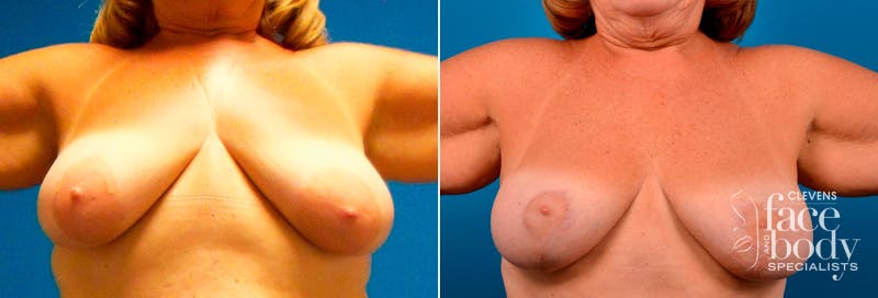 Hidden Breast Lift Before & After Gallery - Patient 410022 - Image 1