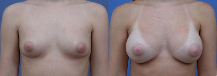 Hidden Breast Aug Before & After Gallery - Patient 263864 - Image 1