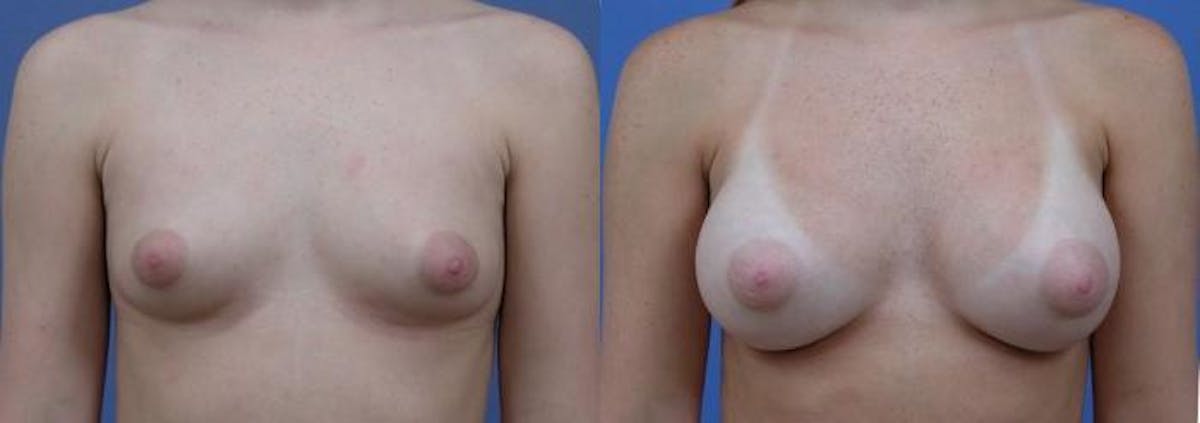 Breast Augmentation Before & After Gallery - Patient 122405456 - Image 1