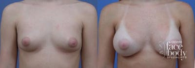 Hidden Breast Aug Before & After Gallery - Patient 368033 - Image 1