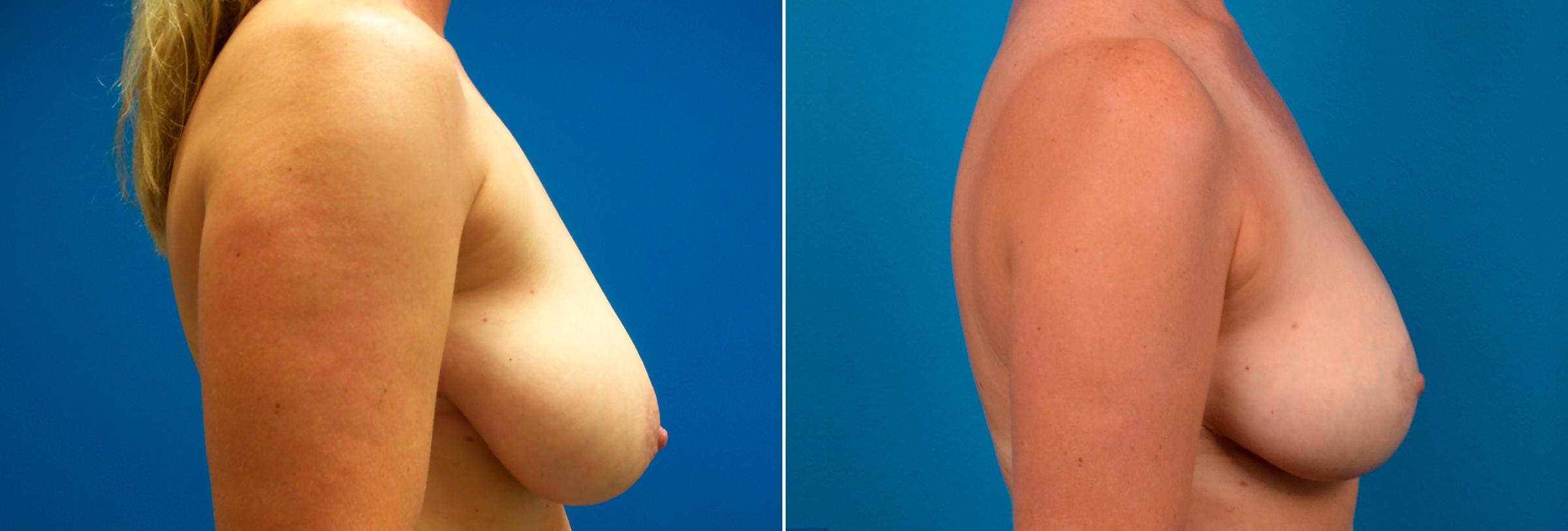 Hidden Breast Reduction Before & After Gallery - Patient 368955 - Image 2