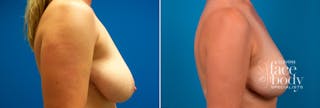 Hidden Breast Reduction Before & After Gallery - Patient 368955 - Image 2