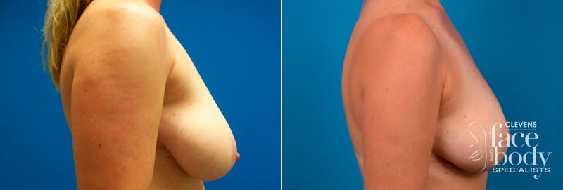 Hidden Breast Reduction Before & After Gallery - Patient 368955 - Image 2