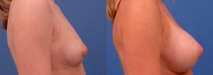 Hidden Breast Aug Before & After Gallery - Patient 263864 - Image 2
