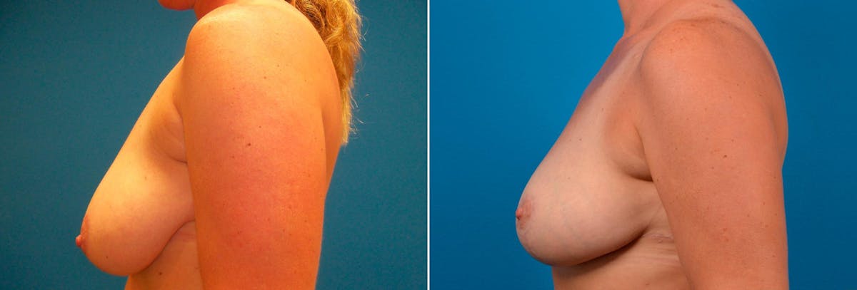 Hidden Breast Reduction Before & After Gallery - Patient 368955 - Image 3