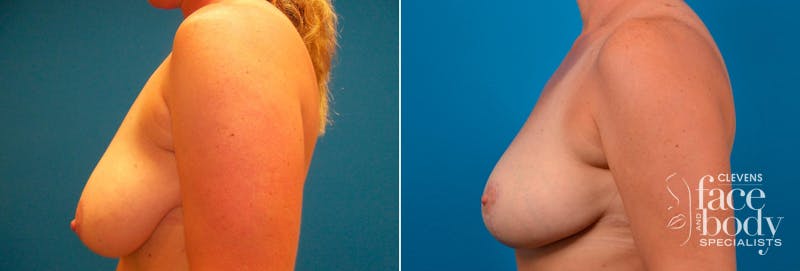 Hidden Breast Reduction Before & After Gallery - Patient 368955 - Image 3