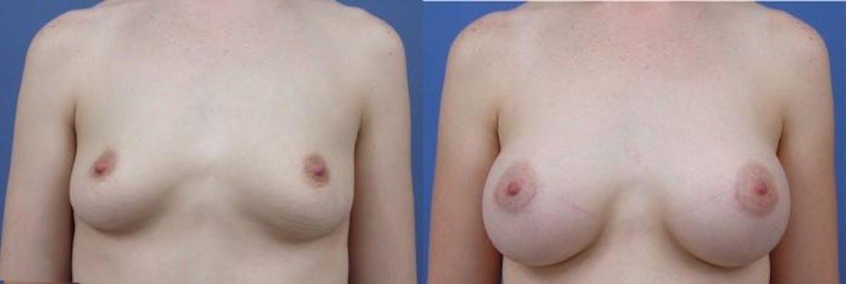 Breast Augmentation Before & After Gallery - Patient 835821 - Image 1