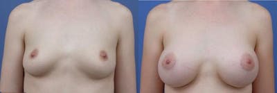 Breast Augmentation Before & After Gallery - Patient 122405458 - Image 1