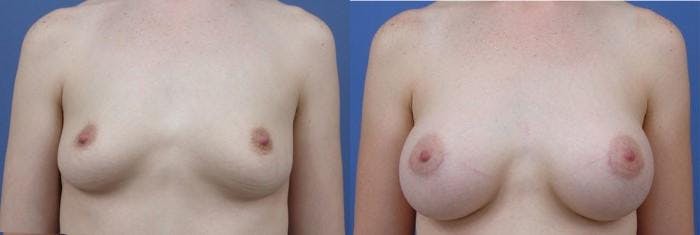 Breast Augmentation Before & After Gallery - Patient 122405458 - Image 1