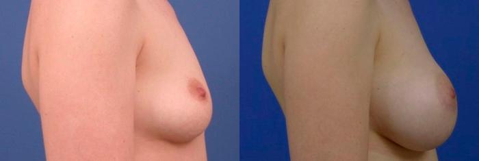Hidden Breast Aug Before & After Gallery - Patient 303329 - Image 2