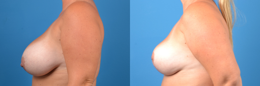 Hidden Breast Lift Before & After Gallery - Patient 106577 - Image 2