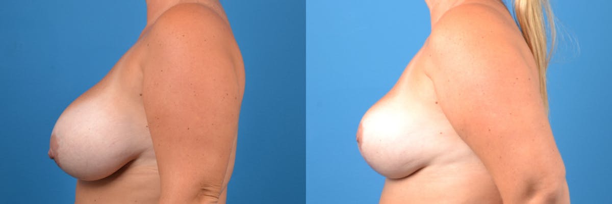 Breast Lift Before & After Gallery - Patient 200422 - Image 2