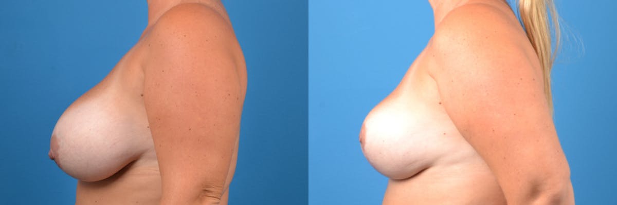 Hidden Breast Lift Before & After Gallery - Patient 157185 - Image 2