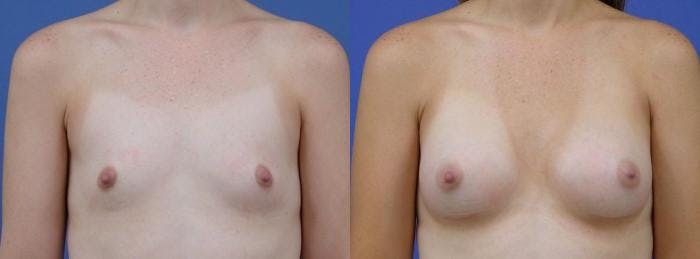 Breast Augmentation Before & After Gallery - Patient 122405460 - Image 1