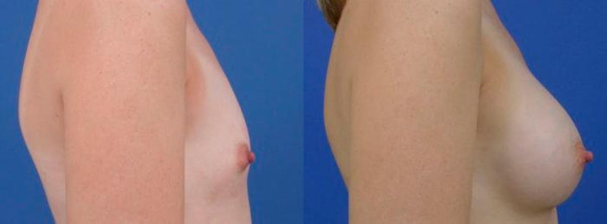 Breast Augmentation Before & After Gallery - Patient 575460 - Image 2