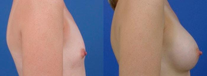 Breast Augmentation Before & After Gallery - Patient 122405460 - Image 2