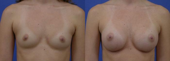 Hidden Breast Aug Before & After Gallery - Patient 326196 - Image 1
