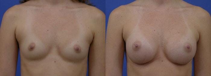 Breast Augmentation Before & After Gallery - Patient 122405461 - Image 1