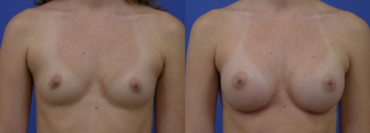 Breast Augmentation Before & After Gallery - Patient 122405461 - Image 1