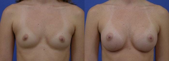 Breast Augmentation Gallery - Patient 122405461 - Image 1