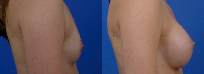 Hidden Breast Aug Before & After Gallery - Patient 326196 - Image 2