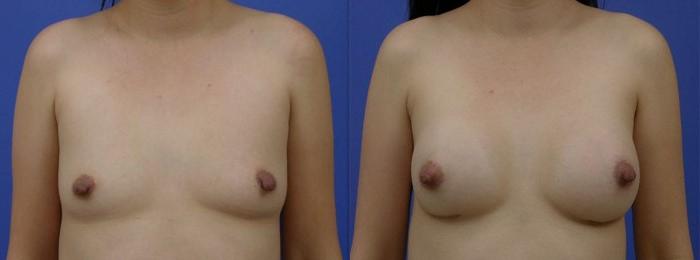 Hidden Breast Aug Before & After Gallery - Patient 332519 - Image 1