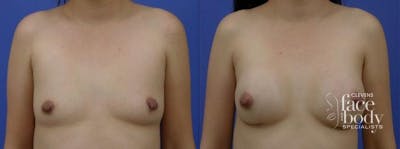 Hidden Breast Aug Before & After Gallery - Patient 332519 - Image 1