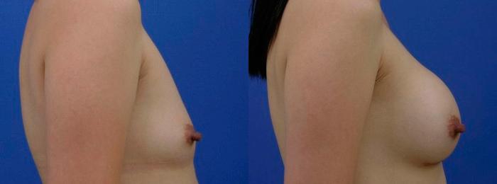 Hidden Breast Aug Before & After Gallery - Patient 332519 - Image 2