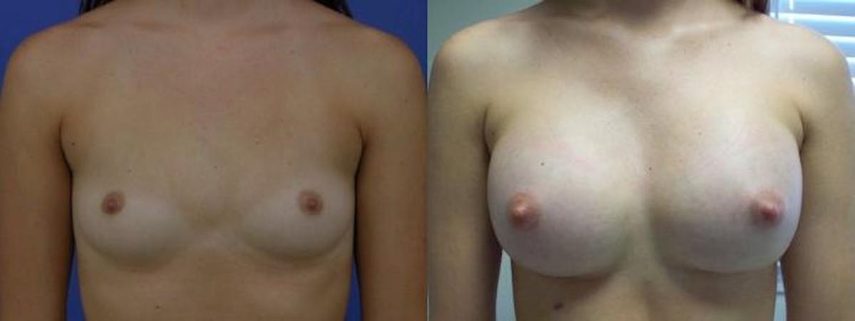 Breast Augmentation Before & After Gallery - Patient 122405463 - Image 1
