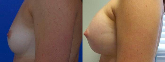 Hidden Breast Aug Before & After Gallery - Patient 313962 - Image 2