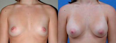 Breast Augmentation Before & After Gallery - Patient 417491 - Image 1
