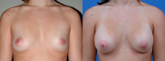 Breast Augmentation Before & After Gallery - Patient 122405464 - Image 1