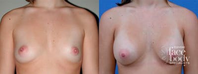 Hidden Breast Aug Before & After Gallery - Patient 125414 - Image 1