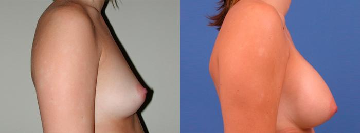 Hidden Breast Aug Before & After Gallery - Patient 211318 - Image 2