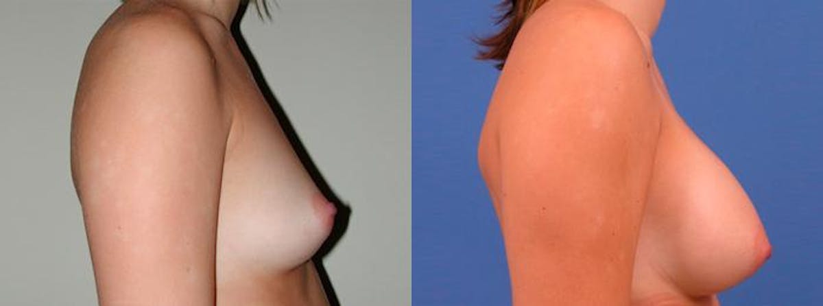 Breast Augmentation Before & After Gallery - Patient 417491 - Image 2